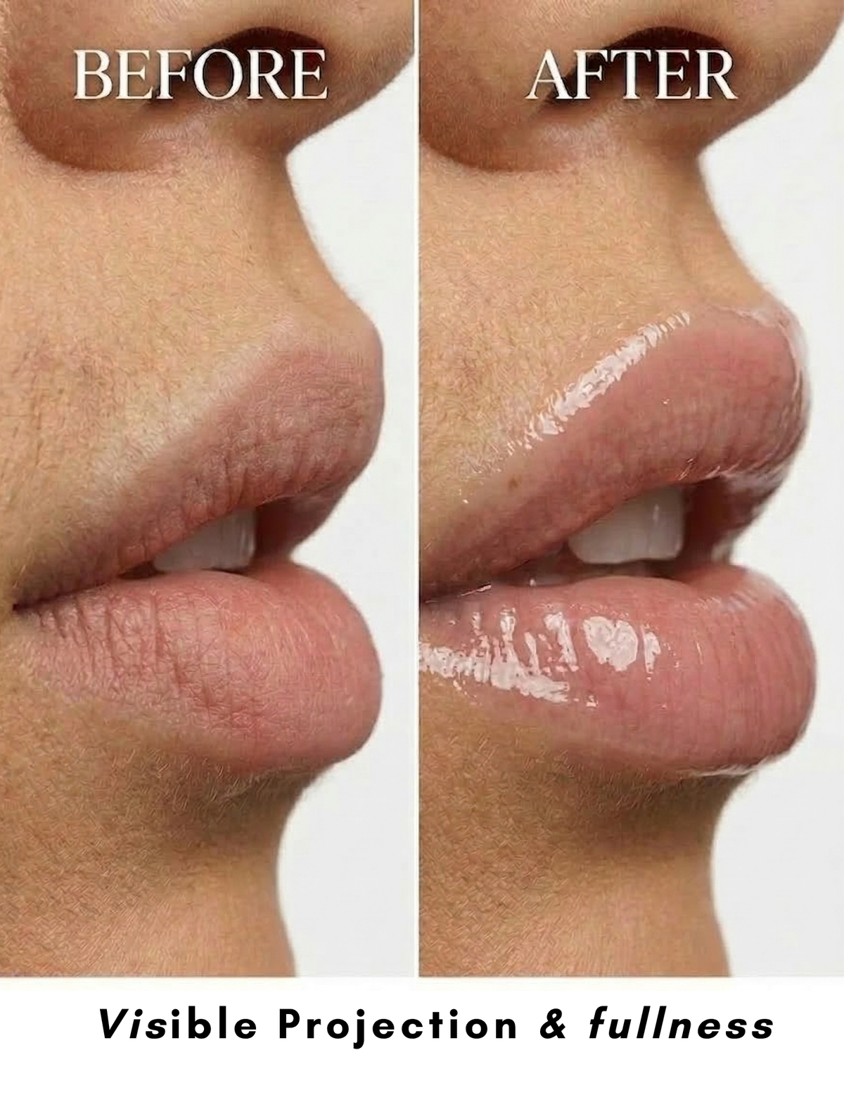 Before and after comparison of lips with visible projection and fullness.